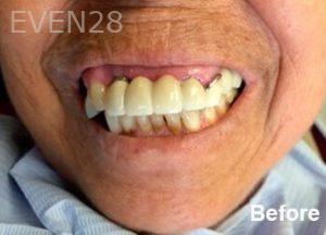 Dean-Garica-All-on-Four-Dental-Implants-before-5