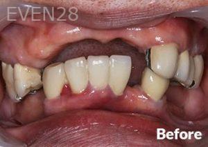 Dean-Garica-All-on-Four-Dental-Implants-before-6