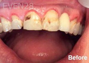 Dean-Garica-Dental-Crowns-before-1