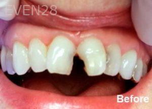 Dean-Garica-Dental-Crowns-before-2