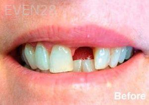 Dean-Garica-Dental-Implants-before-1