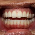 Dich-Lu-Invisalign-clear-aligners-after-1