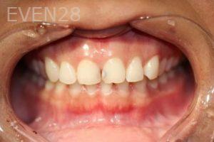Dina-Aleissa-Dental-Bonding-before-1