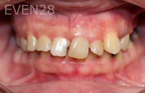 Dina-Aleissa-Dental-Crowns-before-1