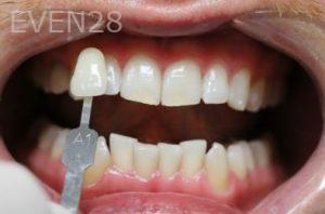 Dina-Aleissa-Teeth-Whitening-after-1