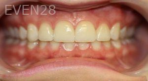 Farzin-Allameh-Dental-Bonding-after-1