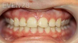 Farzin-Allameh-Dental-Bonding-before-1