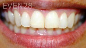 Farzin-Allameh-Dental-Bonding-before-2