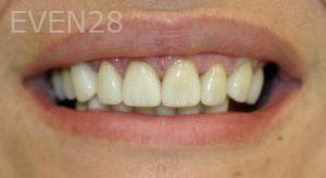 Farzin-Allameh-Dental-Crowns-after-2
