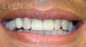 Farzin-Allameh-Dental-Crowns-after-3