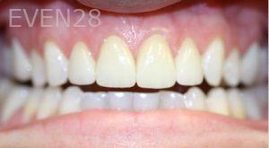 Farzin-Allameh-Dental-Crowns-after-4