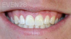 Farzin-Allameh-Dental-Crowns-after-5