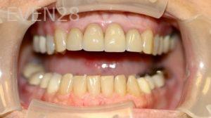 Farzin-Allameh-Dental-Crowns-before-1