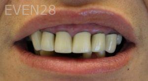Farzin-Allameh-Dental-Crowns-before-2