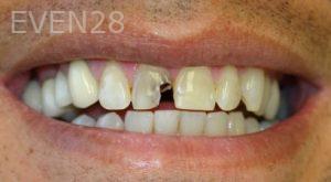 Farzin-Allameh-Dental-Crowns-before-3