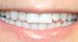 Farzin-Allameh-Dental-Crowns-before-4