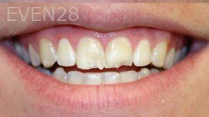 Farzin-Allameh-Dental-Crowns-before-5