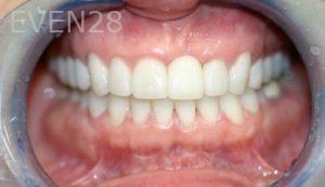 Farzin-Allameh-Dental-Implants-after-1