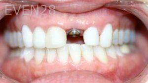 Farzin-Allameh-Dental-Implants-before-1