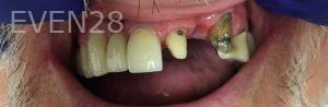 Garrett-Rubio-Dental-Bridge-before-1b