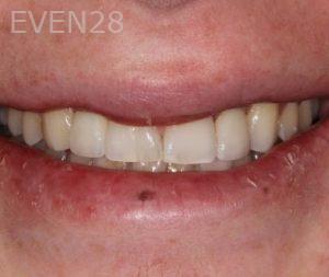 Garrett-Rubio-Porcelain-Veneers-after-1