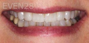 Garrett-Rubio-Porcelain-Veneers-after-2