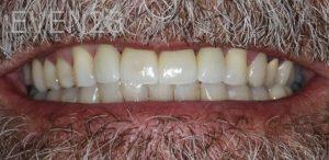 Garrett-Rubio-Porcelain-Veneers-after-3