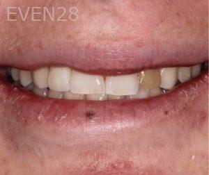 Garrett-Rubio-Porcelain-Veneers-before-1