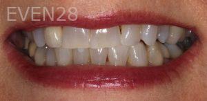 Garrett-Rubio-Porcelain-Veneers-before-2