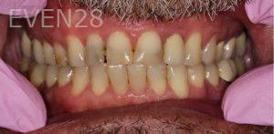 Garrett-Rubio-Porcelain-Veneers-before-3