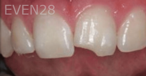 Guitta-Harb-Dental-Bonding-Before-2