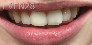 Guitta-Harb-Dental-Bonding-After-4