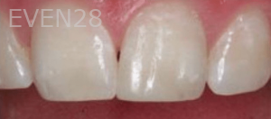Guitta-Harb-Dental-Bonding-After-2