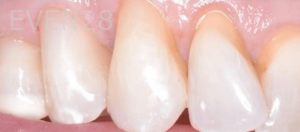 Guitta-Harb-Dental-Crowns-After-1
