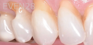 Guitta-Harb-Dental-Crowns-Before-1