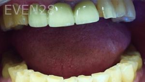 Guitta-Harb-Dental-Crowns-Before-2