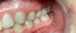 Guitta-Harb-Dental-Implant-After-1