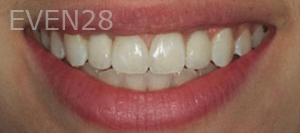 Guitta-Harb-Dental-Implant-After-2