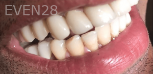 Guitta-Harb-Dental-Implant-After-3