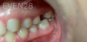 Guitta-Harb-Dental-Implant-Before-1