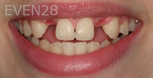 Guitta-Harb-Dental-Implant-Before-2