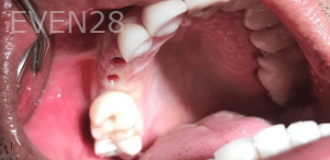 Guitta-Harb-Dental-Implant-Before-3