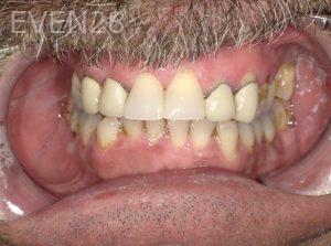 Hermant-Patel-Dental-Crown-after-1