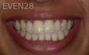Hermant-Patel-Dental-Crown-after-2