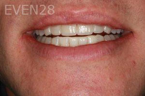 Hermant-Patel-Dental-Crown-after-3