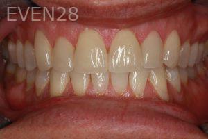 Hermant-Patel-Dental-Crown-after-4