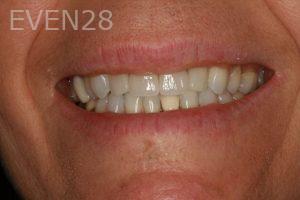 Hermant-Patel-Dental-Crown-after-5