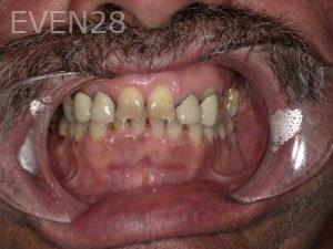 Hermant-Patel-Dental-Crown-before-1