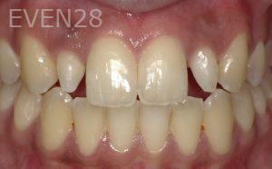 Hermant-Patel-Dental-Crown-before-2