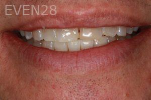Hermant-Patel-Dental-Crown-before-3